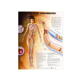 Hlboká žilová trombóza (DVT) - plagát