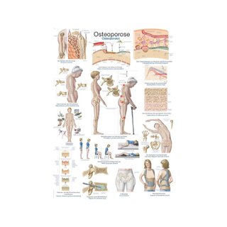 Plagát Osteoporóza - Anatomický plagát 50x70cm