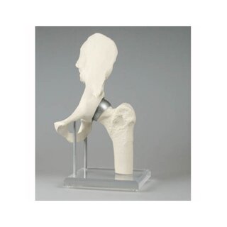 Model bedrového kĺbu s implantátom - Birmingham Hip