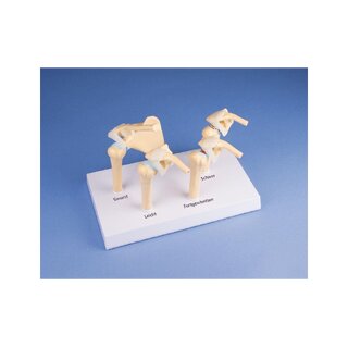 Model ramena so 4 štádiami osteoartrózy (OA)
