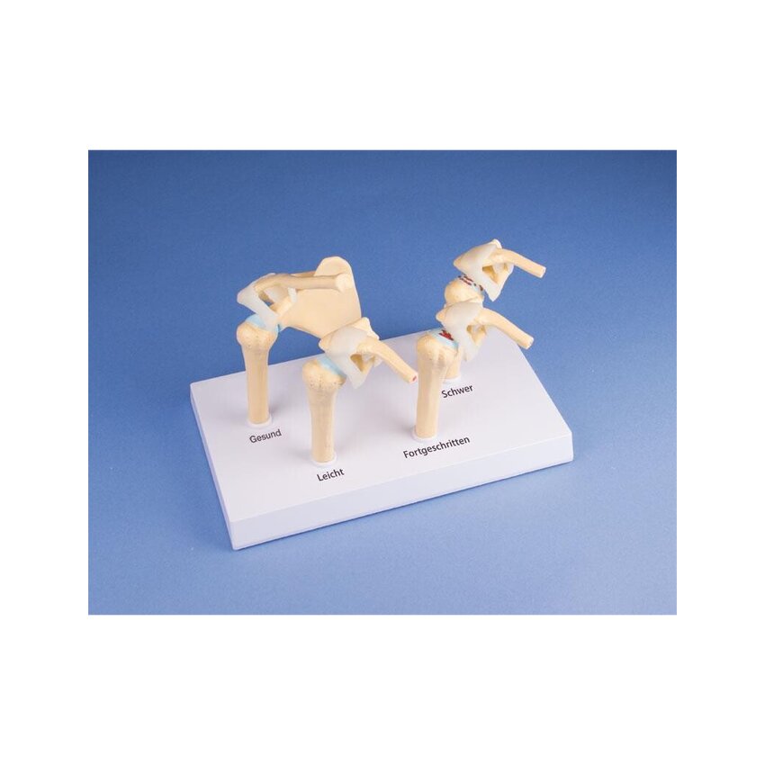 Model ramena so 4 štádiami osteoartrózy (OA)